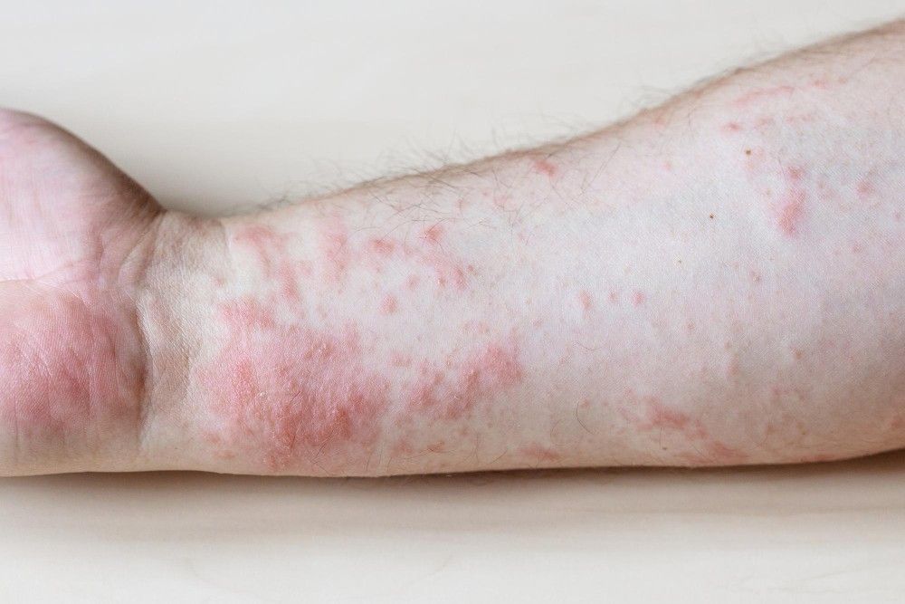 Lichen-Planus