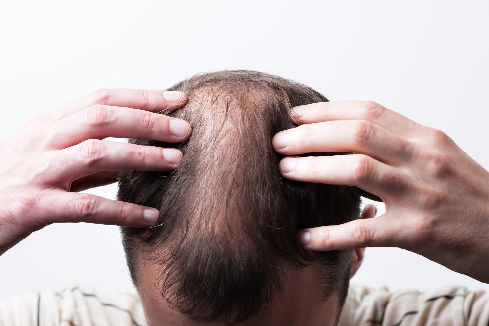 Male-Pattern-Baldness