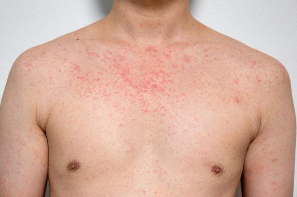 Urticaria