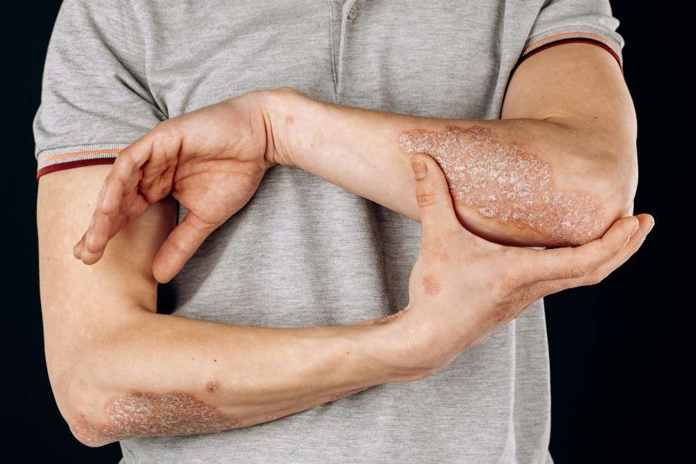 Psoriasis